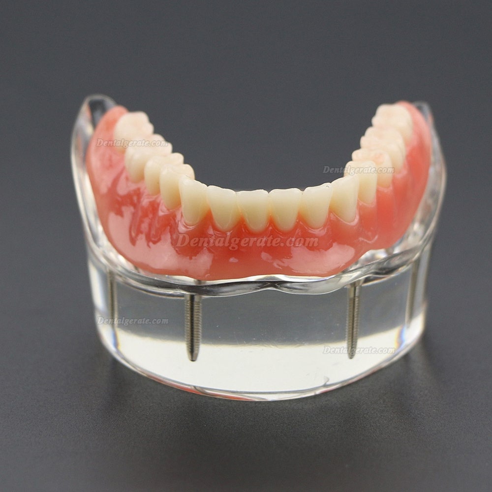 Dental Lower Z&auml;hne Demo-Studienmodell 6002 02 Overdenture Unten 4 Implantate